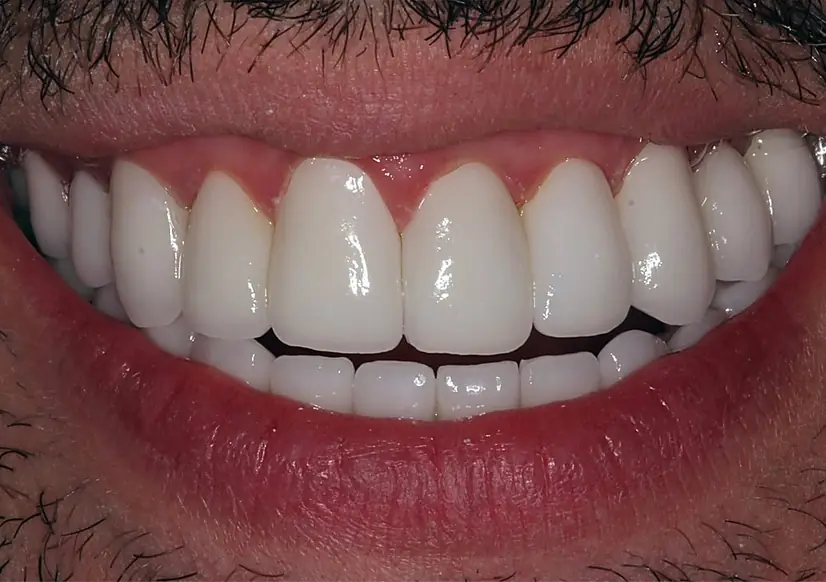 Completed porcelain veneer case.