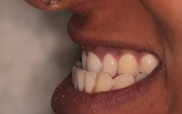 An adult underbite before treatment, the lower jaw sitting ahead of the upper teeth.